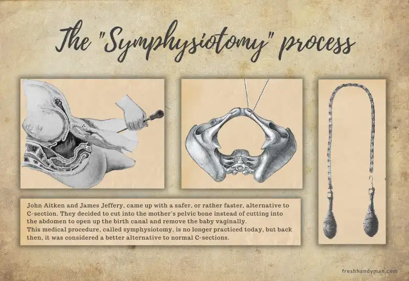 the-symphysiotomy-process